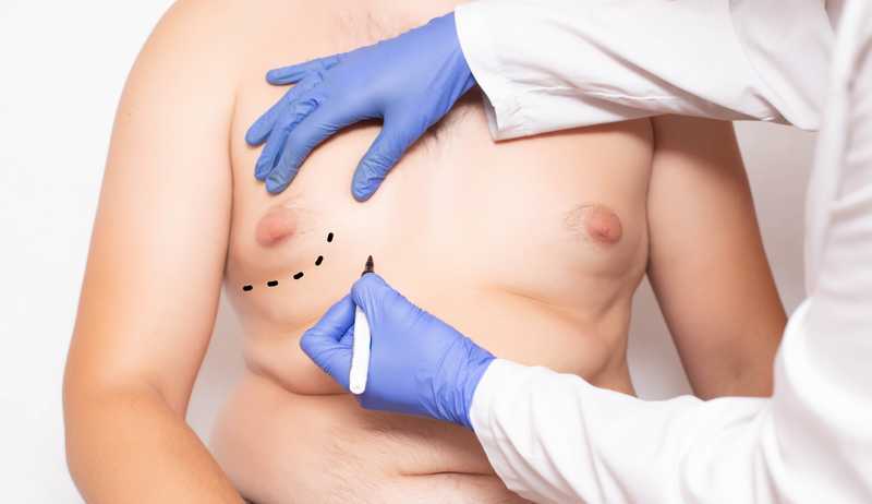 BREAST GROWTH IN MEN; Gynecomastia
